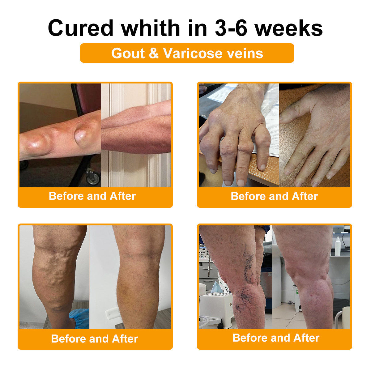 🔥Legkelendőbb丨TLOPA® Botulinum Toxin és Méhméreg Fájdalomcsillapító Csontgyógyító Krém🐝 🔥(Kifejezetten időseknek & ortopéd szakorvosok ajánlásával)🦴