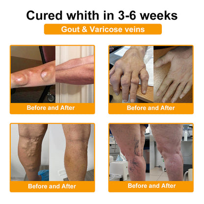 🔥Legkelendőbb丨TLOPA® Botulinum Toxin és Méhméreg Fájdalomcsillapító Csontgyógyító Krém🐝 🔥(Kifejezetten időseknek & ortopéd szakorvosok ajánlásával)🦴